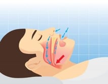 airway, obstructive sleep apnea