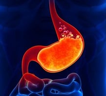 gastric reflux